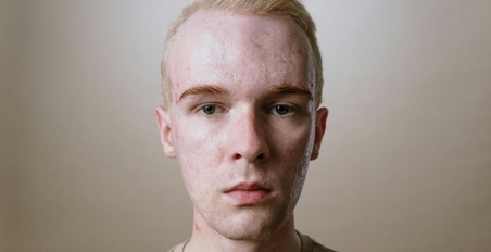 جای جوش و اسکار آکنه: چه درمانهایی دارد؟