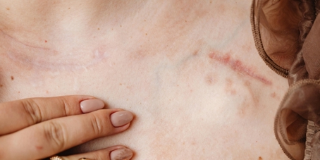 جای زخم یا اسکار (Scar) دقیقاً چیست و انواع آن چگونه است؟